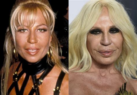 que cirugias se hizo donatella versace